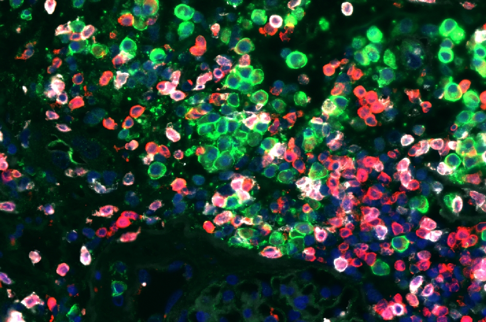 Immunfluoreszenz-Färbung von CD3+, CD8+ und CD38+ Zellen in einer Transplantat-Biopsie eines Patienten mit T Zell-vermittelter  Abstoßung.