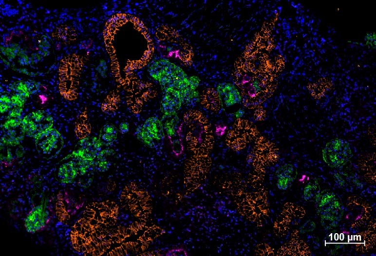 Immunfluoreszenz-Färbung von Podozyten, distalen und proximalen Tubuli in einem Nierenorganoid aus humanen Stammzellen.
